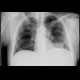 Metastases of lung and mediastinum: X-ray - Plain radiograph